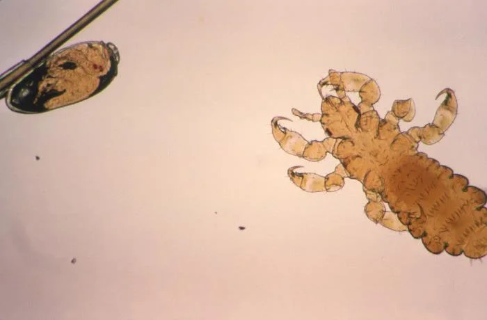 Lente de poux vivante collée à un cheveu, vue au microscope : l'œuf ovale laisse voir l'embryon et ses yeux rouges, à côté d'un jeune pou