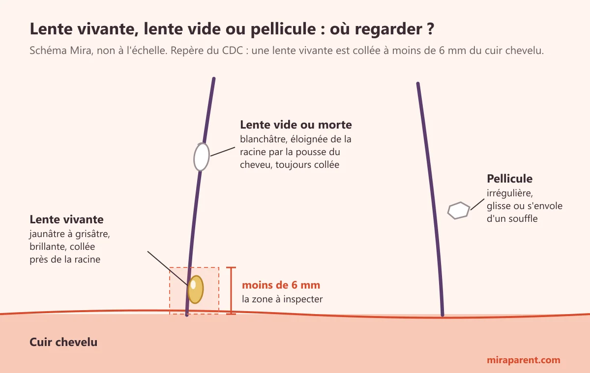 Schéma d'un cheveu sur le cuir chevelu : lente vivante jaunâtre à moins de 6 mm de la racine, lente vide blanchâtre plus haut sur le cheveu, pellicule libre à côté